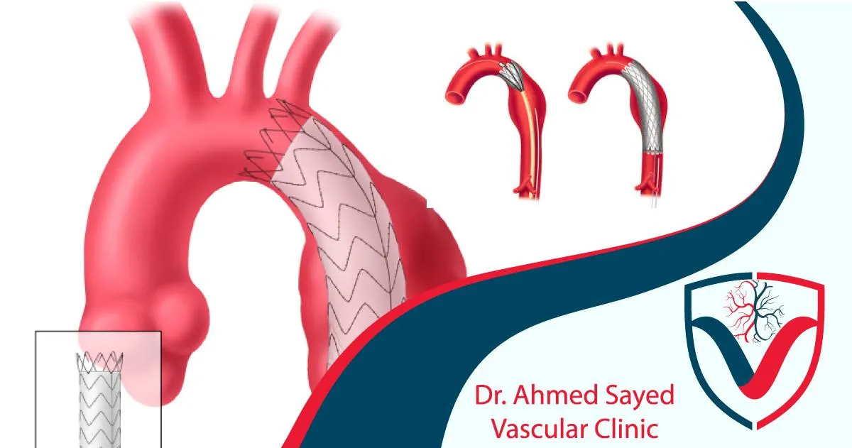تمدد الشريان الاورطي