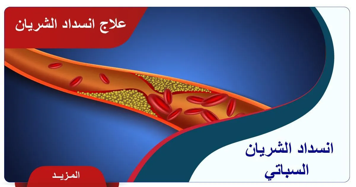 علاج انسداد الشريان السباتي