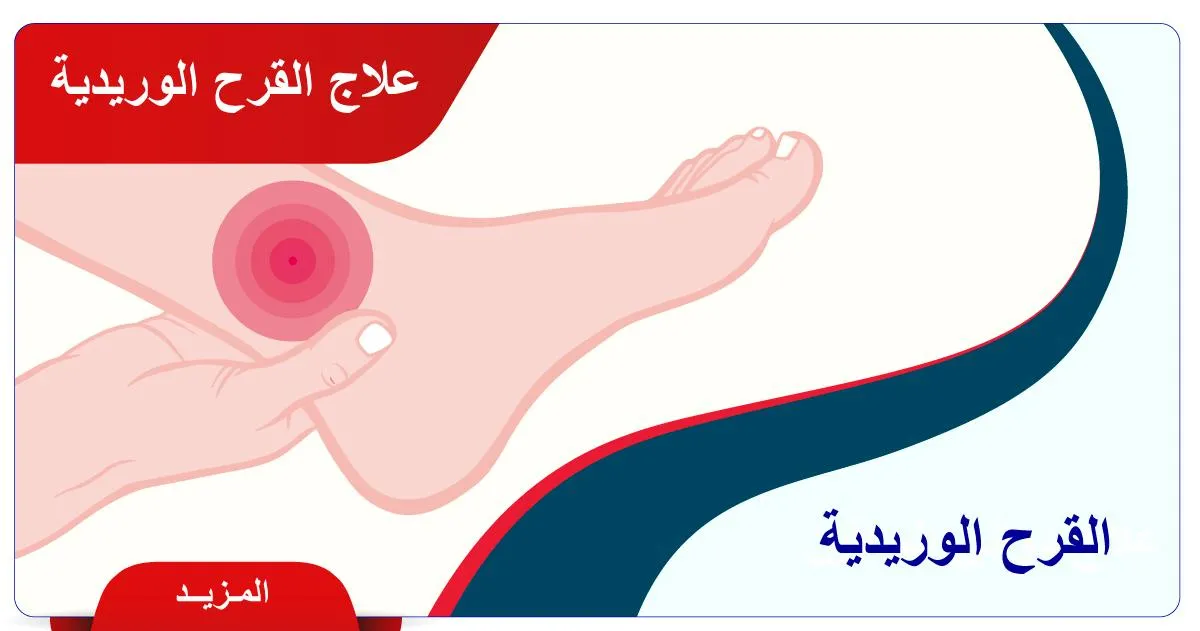 علاج القرح الوريدية